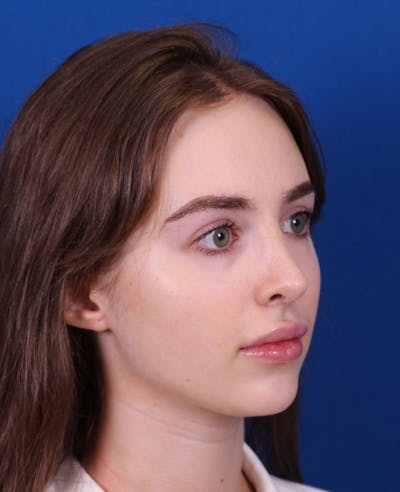 Rhinoplasty Before & After Gallery - Patient 217071 - Image 6