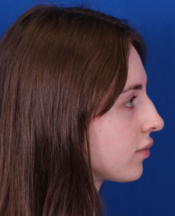 Rhinoplasty Before & After Gallery - Patient 217071 - Image 1