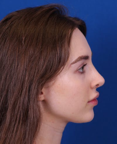 Rhinoplasty Before & After Gallery - Patient 217071 - Image 2