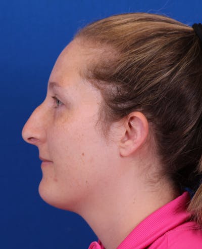 Rhinoplasty Before & After Gallery - Patient 176721 - Image 1