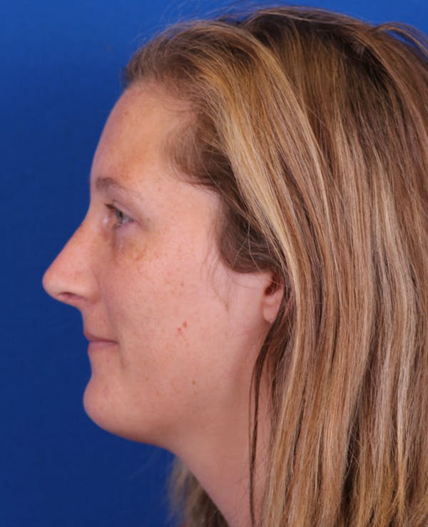 Rhinoplasty Before & After Gallery - Patient 176721 - Image 2