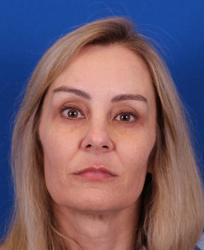 Facelift/Neck Lift Before & After Gallery - Patient 341658 - Image 1