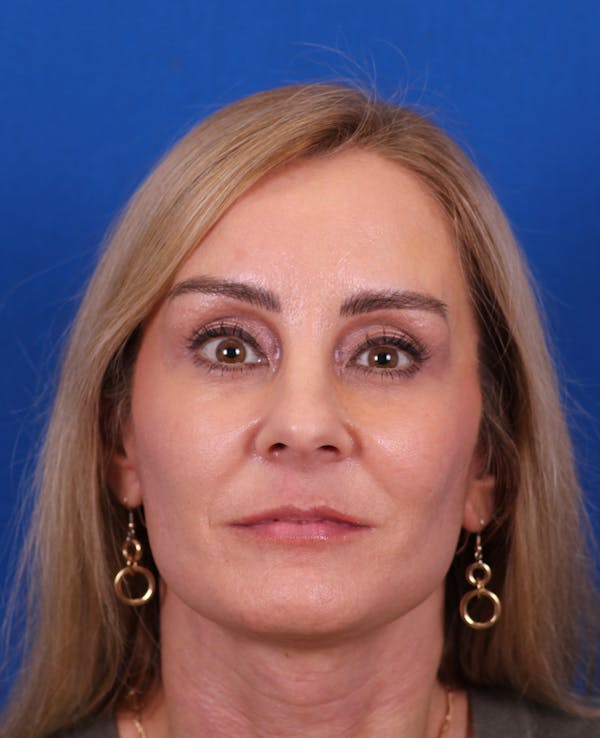 Facelift/Neck Lift Before & After Gallery - Patient 341658 - Image 2