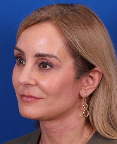 Facelift/Neck Lift Before & After Gallery - Patient 341658 - Image 4