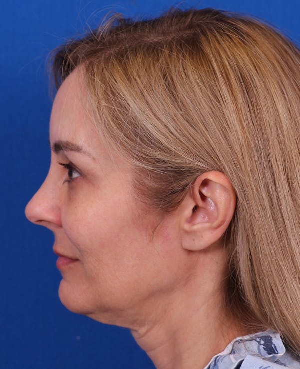 Facelift/Neck Lift Before & After Gallery - Patient 341658 - Image 5