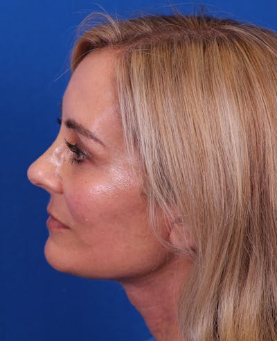 Facelift/Neck Lift Before & After Gallery - Patient 341658 - Image 6