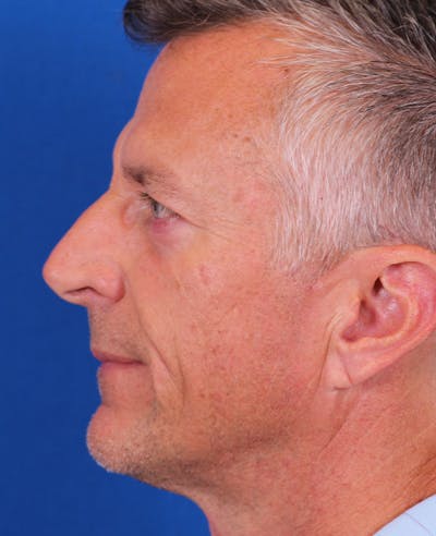 Rhinoplasty Before & After Gallery - Patient 328732 - Image 1
