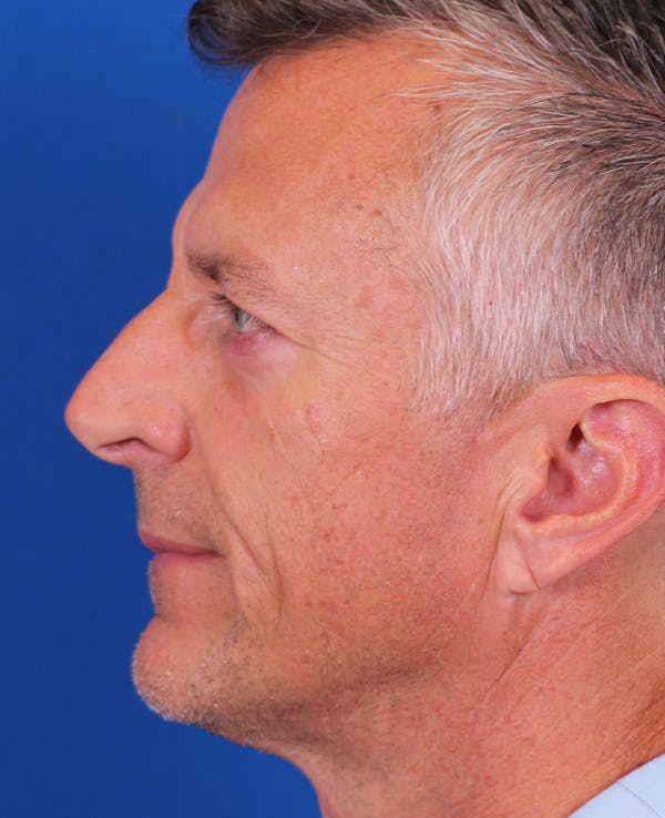 Rhinoplasty Before & After Gallery - Patient 328732 - Image 1