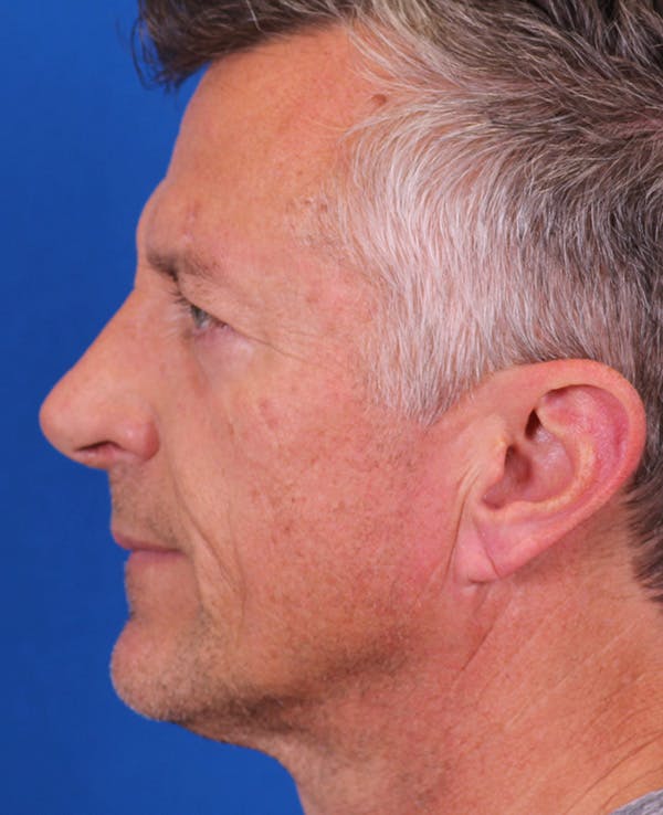 Rhinoplasty Before & After Gallery - Patient 328732 - Image 2