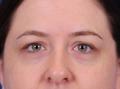 Blepharoplasty Before & After Gallery - Patient 291521 - Image 1