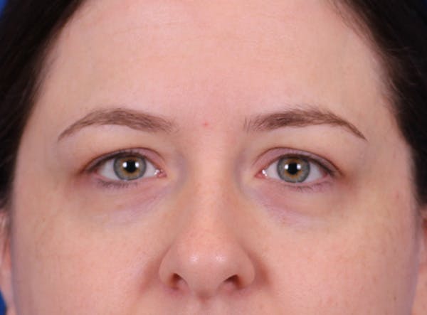 Brow Lift Before & After Gallery - Patient 171579 - Image 1