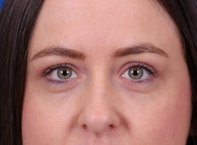 Blepharoplasty Before & After Gallery - Patient 291521 - Image 2
