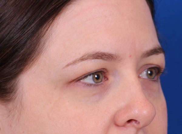 Brow Lift Before & After Gallery - Patient 171579 - Image 3