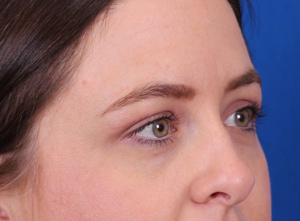 Brow Lift Before & After Gallery - Patient 171579 - Image 4
