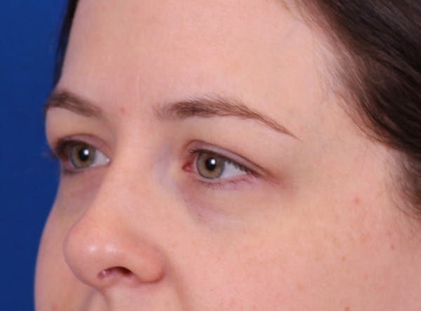 Brow Lift Before & After Gallery - Patient 171579 - Image 5
