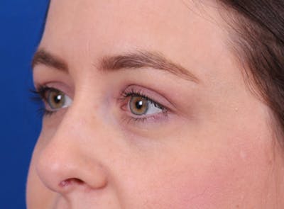 Brow Lift Before & After Gallery - Patient 171579 - Image 6