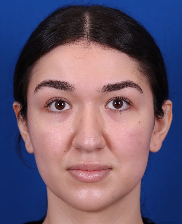 Rhinoplasty Before & After Gallery - Patient 467052 - Image 5