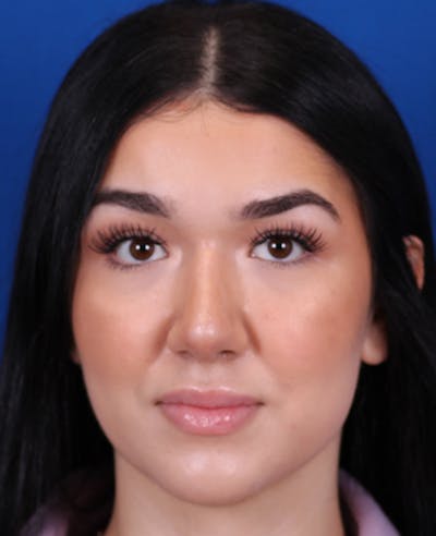 Rhinoplasty Before & After Gallery - Patient 467052 - Image 6
