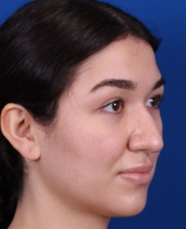Rhinoplasty Before & After Gallery - Patient 467052 - Image 3