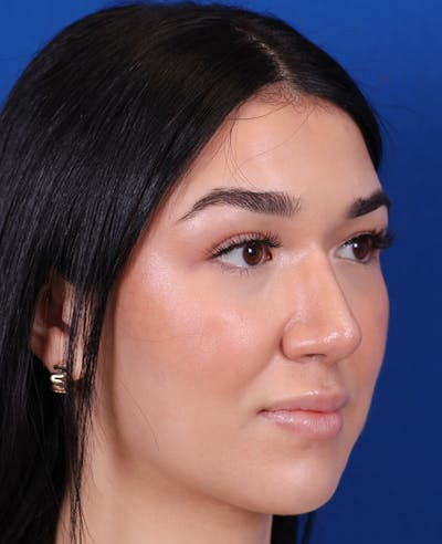Rhinoplasty Before & After Gallery - Patient 467052 - Image 4
