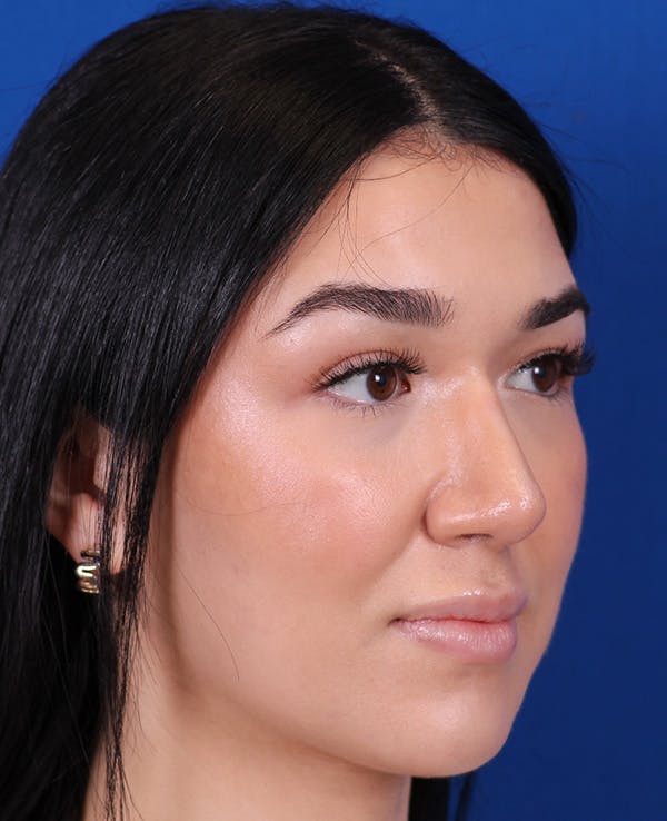 Rhinoplasty Before & After Gallery - Patient 467052 - Image 4