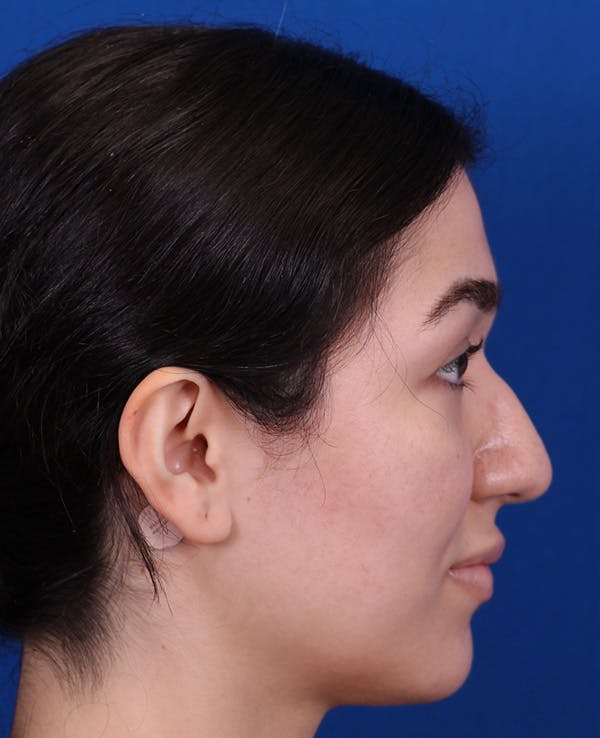 Rhinoplasty Before & After Gallery - Patient 467052 - Image 1