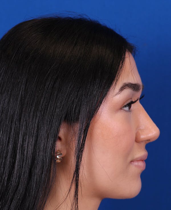 Rhinoplasty Before & After Gallery - Patient 467052 - Image 2