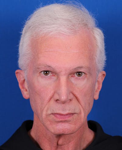 Facelift/Neck Lift Before & After Gallery - Patient 156903 - Image 1