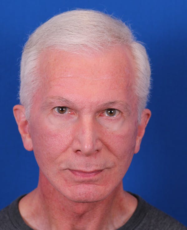 Facelift/Neck Lift Before & After Gallery - Patient 156903 - Image 2