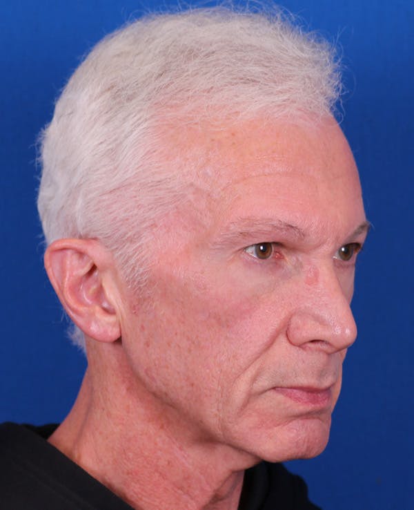 Facelift/Neck Lift Before & After Gallery - Patient 156903 - Image 3