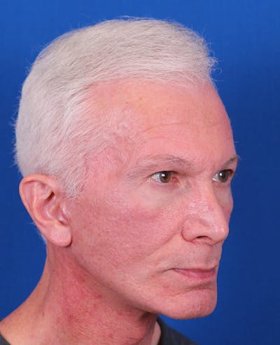Facelift/Neck Lift Before & After Gallery - Patient 156903 - Image 4
