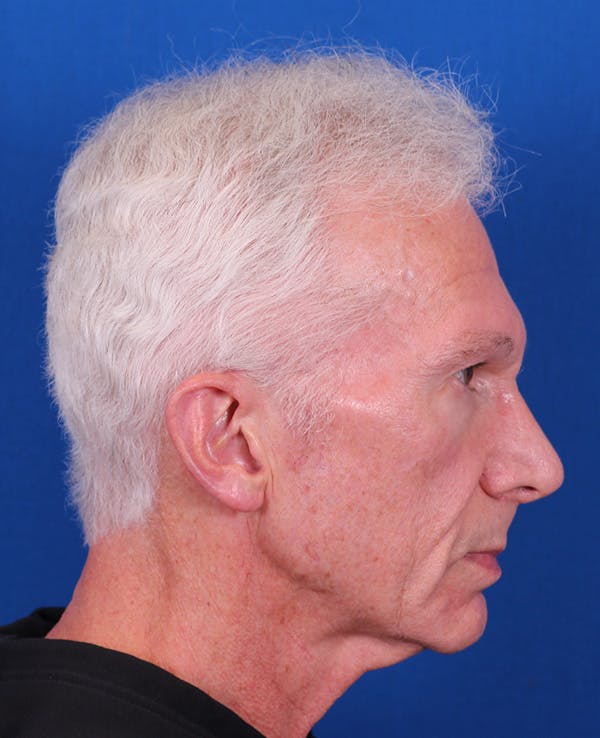 Facelift/Neck Lift Before & After Gallery - Patient 156903 - Image 5