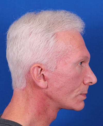 Facelift/Neck Lift Before & After Gallery - Patient 156903 - Image 6