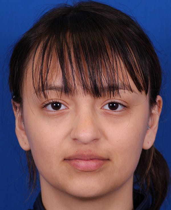Rhinoplasty Before & After Gallery - Patient 428762 - Image 5