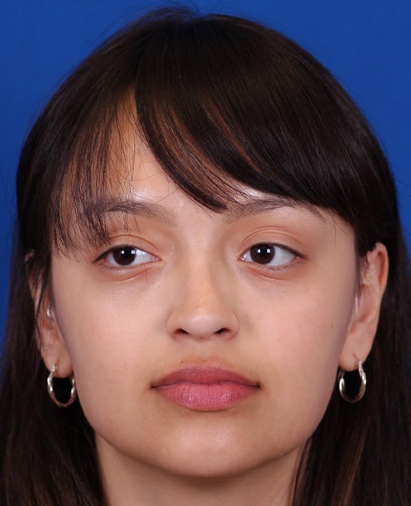 Rhinoplasty Before & After Gallery - Patient 428762 - Image 6