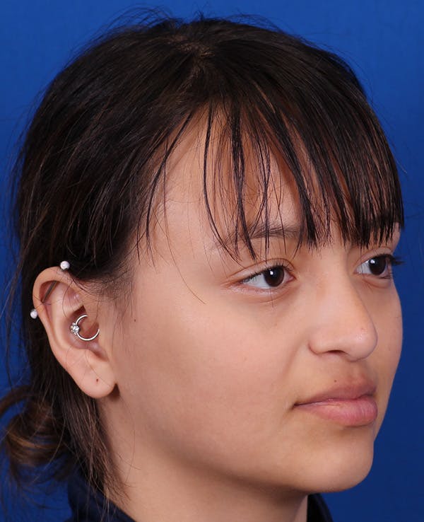 Rhinoplasty Before & After Gallery - Patient 428762 - Image 3