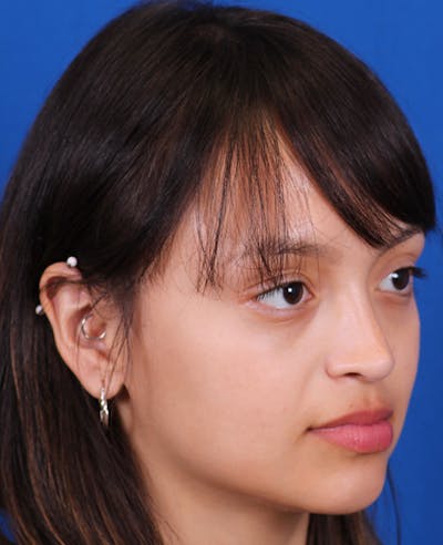 Rhinoplasty Before & After Gallery - Patient 428762 - Image 4