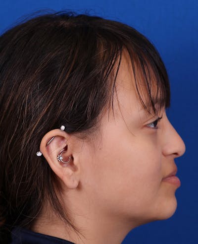 Rhinoplasty Before & After Gallery - Patient 428762 - Image 1