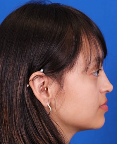 Rhinoplasty Before & After Gallery - Patient 428762 - Image 2