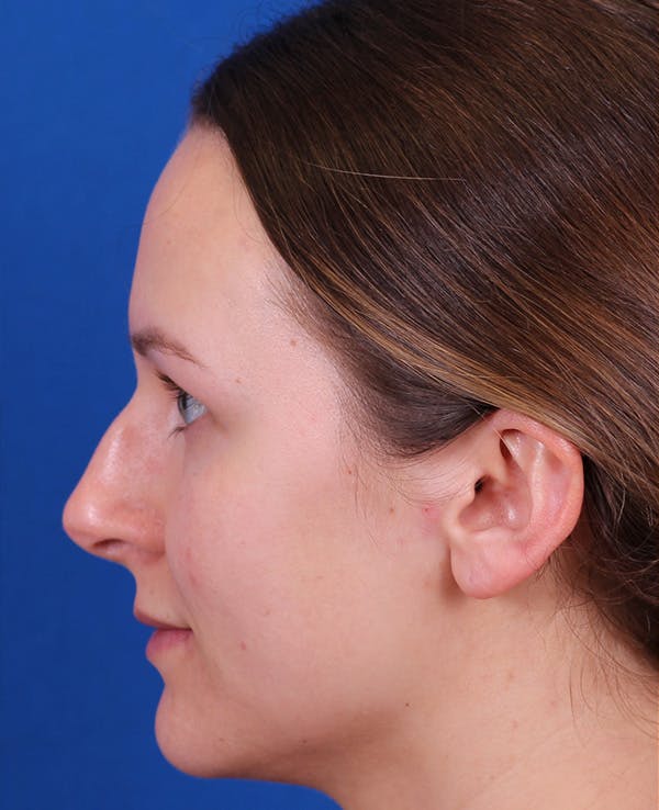 Rhinoplasty Before & After Gallery - Patient 372670 - Image 1