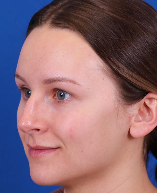 Rhinoplasty Before & After Gallery - Patient 372670 - Image 3