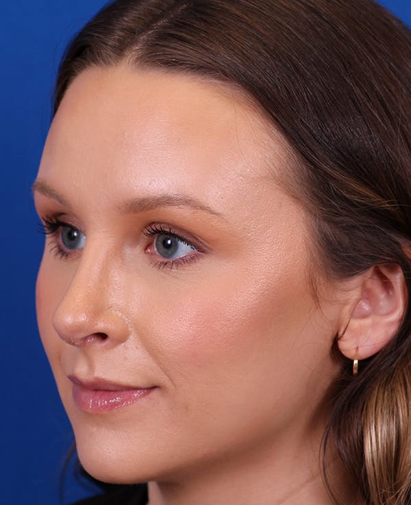 Rhinoplasty Before & After Gallery - Patient 372670 - Image 4
