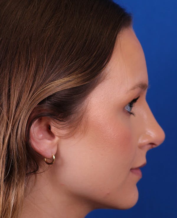 Rhinoplasty Before & After Gallery - Patient 372670 - Image 6