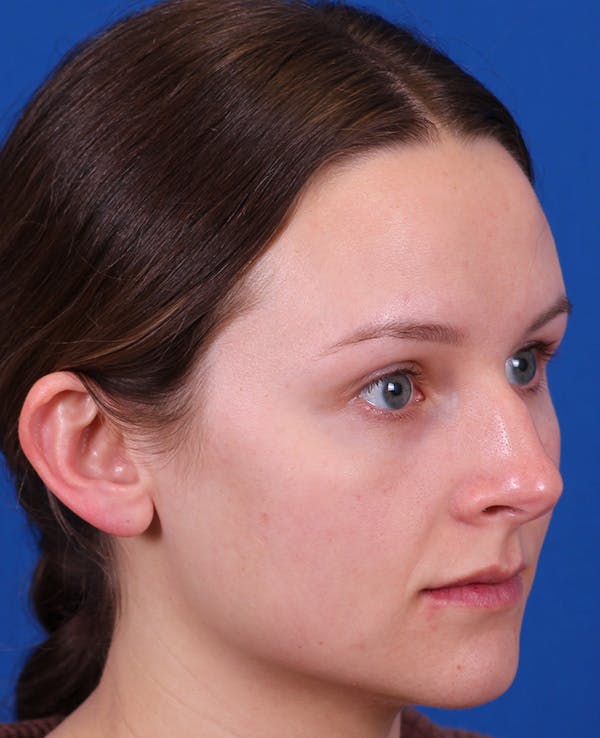 Rhinoplasty Before & After Gallery - Patient 372670 - Image 7