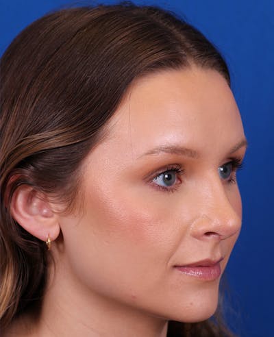 Rhinoplasty Before & After Gallery - Patient 372670 - Image 8