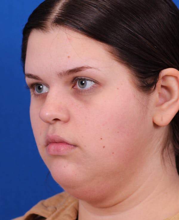 Neck deFINE Before & After Gallery - Patient 331285 - Image 3