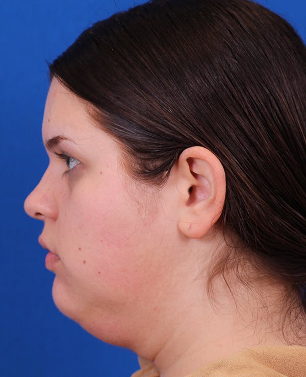 Neck deFINE Before & After Gallery - Patient 331285 - Image 5