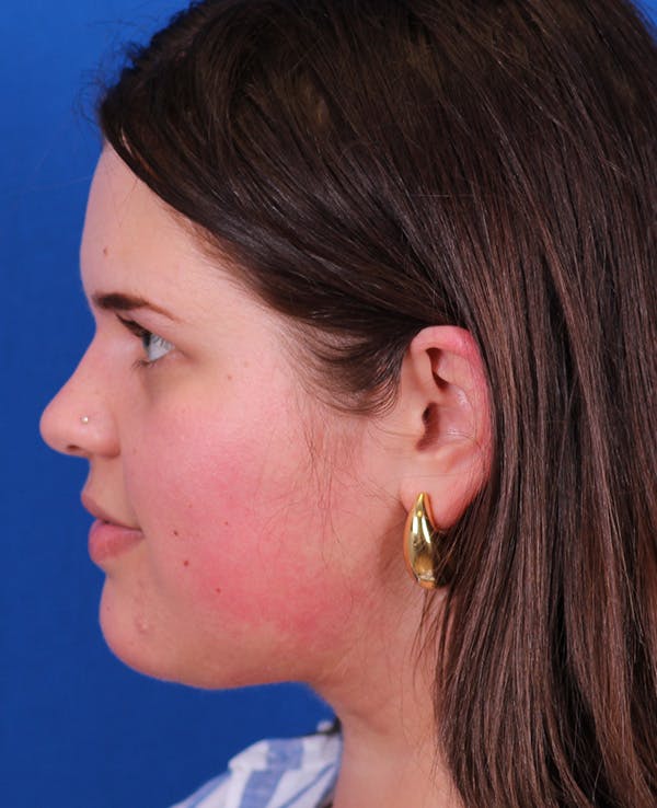 Neck deFINE Before & After Gallery - Patient 331285 - Image 6