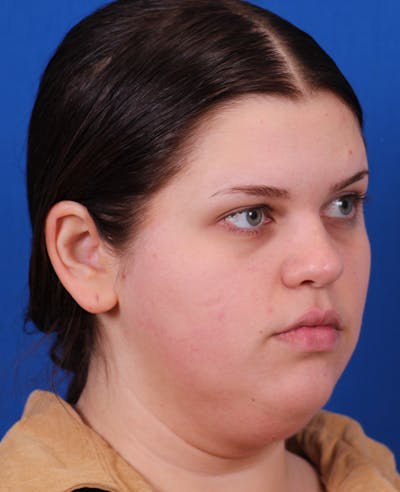 Neck deFINE Before & After Gallery - Patient 331285 - Image 1