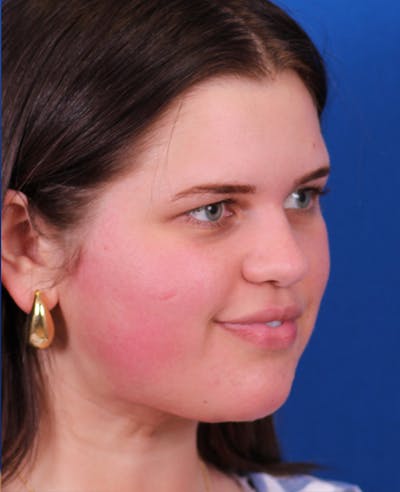 Neck deFINE Before & After Gallery - Patient 331285 - Image 2